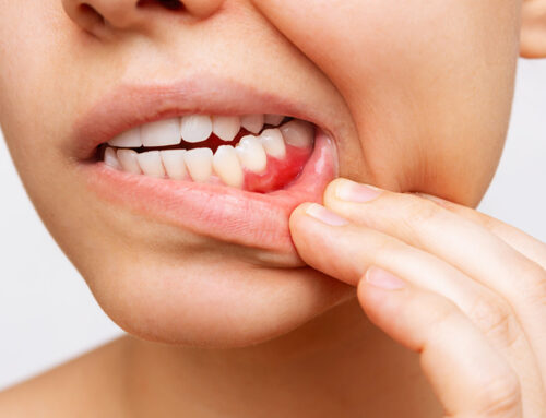 Gengivite e parodontite : perché è importante curarle