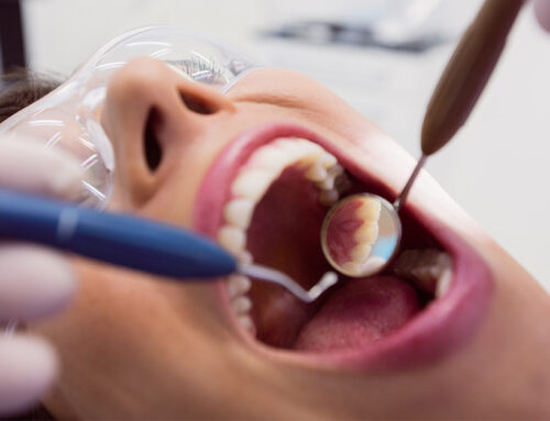  Cos’è l’ intarsio dentale e a cosa serve