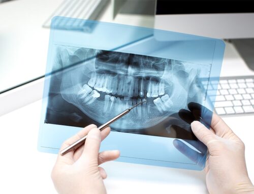 Le radiografie dentali sono pericolose per la salute?